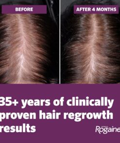 Women's Rogaine 5% Minoxidil Foam for Hair Thinning and Loss, Topical Treatment for Hair Regrowth