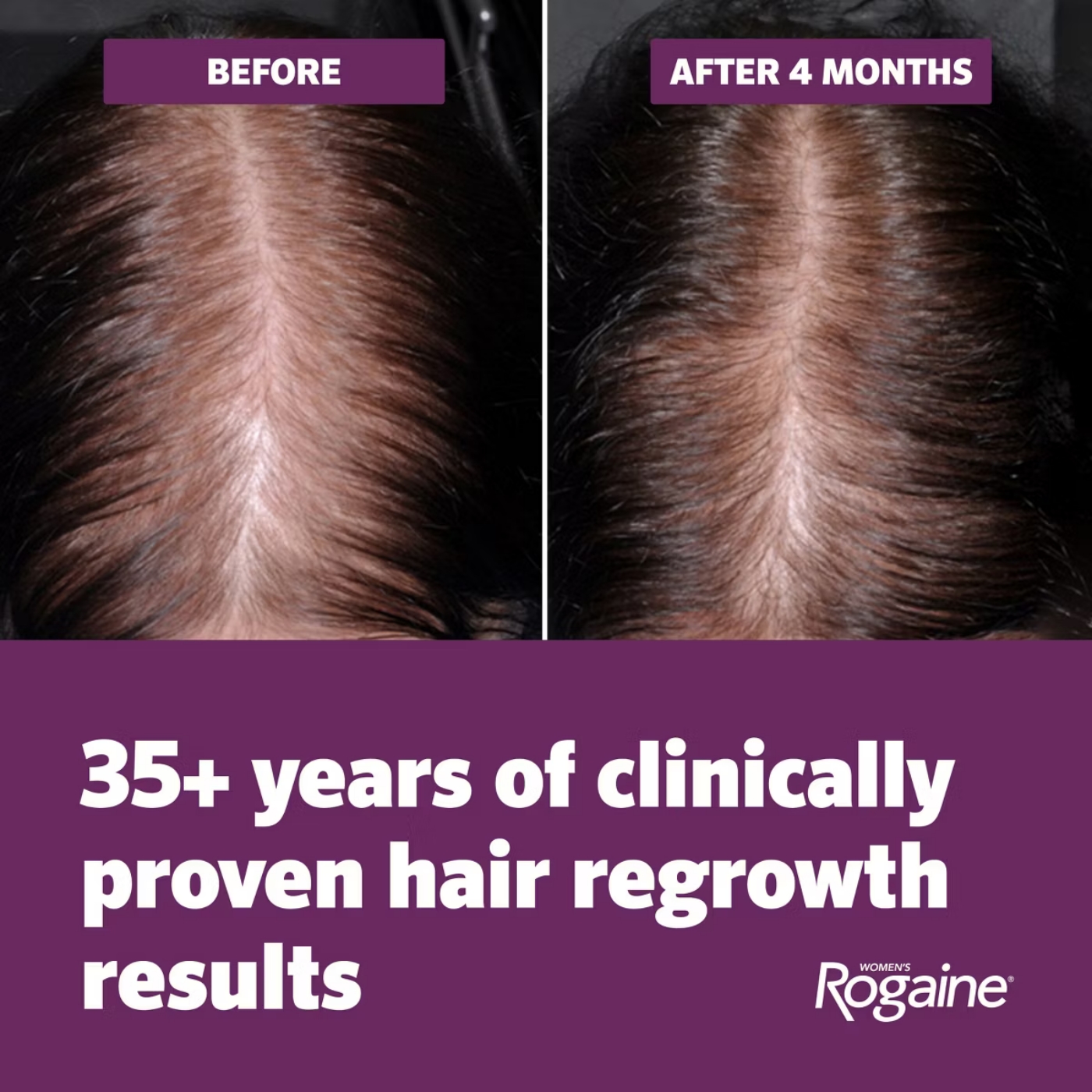 Women's Rogaine 5% Minoxidil Foam for Hair Thinning and Loss, Topical Treatment for Hair Regrowth